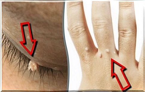 5 natural remedies for warts