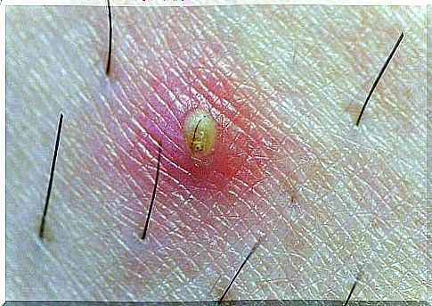 Inflammation caused by hairs growing under the skin