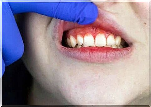 Acute necrotizing ulcerative gingivitis: treatment