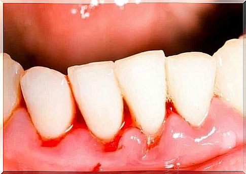 Acute necrotizing ulcerative gingivitis