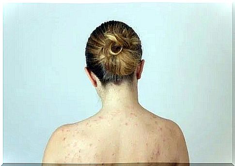 Woman facing fat lumps on her back