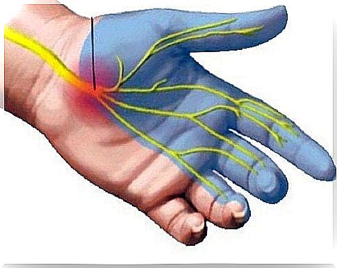 Carpal tunnel syndrome - natural remedies