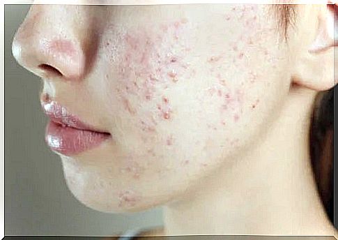 Girl with acne