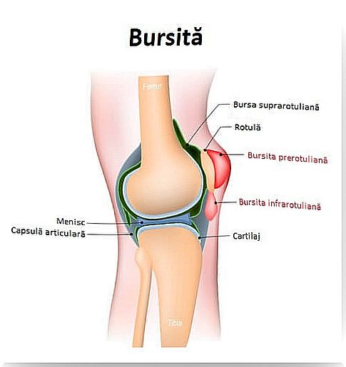 Everything you need to know about bursitis and its complications