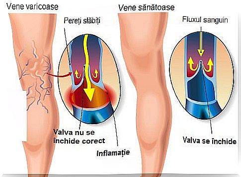 Exercises for varicose veins