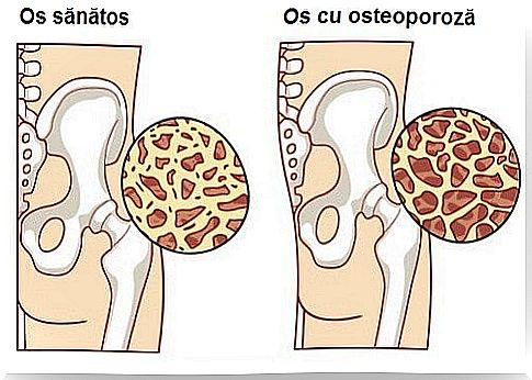 Foods that reduce the risk of osteoporosis