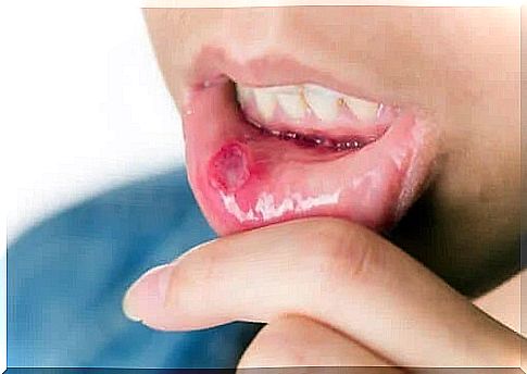 Person with mouth ulcer