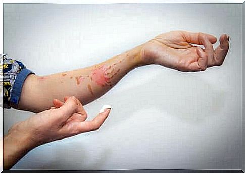 How are superficial burns treated?