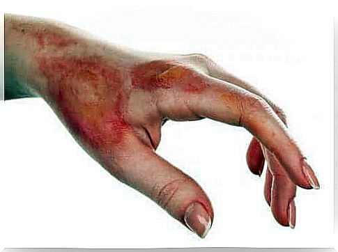 Hand with superficial burns