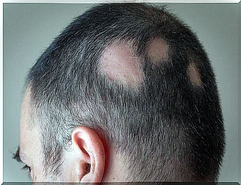 How to fight alopecia with natural solutions