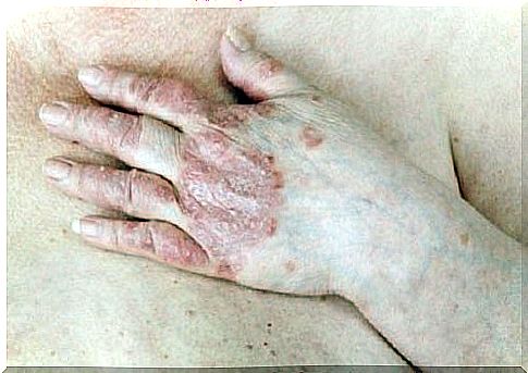 Is it possible to cure psoriasis?