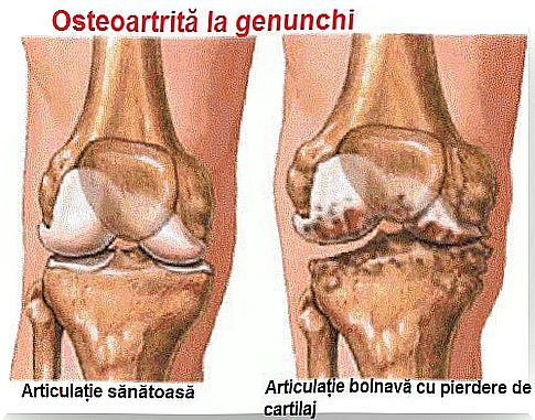 Nocturnal joint pain in the knees