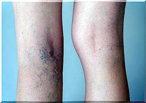 Treatment of varicose veins and the pain caused by them