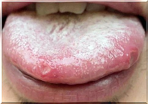 Remedies for oral candidiasis: natural alternatives