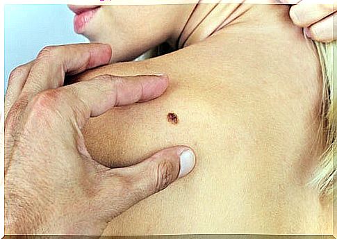 Skin cancer: 7 important information