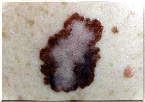 Skin cancer can develop in a mole