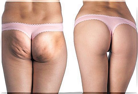 The best natural treatments against cellulite