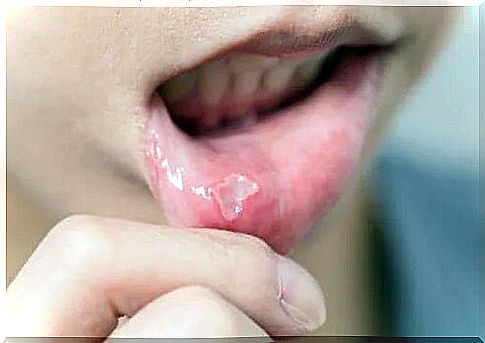 Treatment of canker sores in children