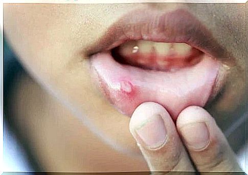 Little girl who needs canker sores treatment in children