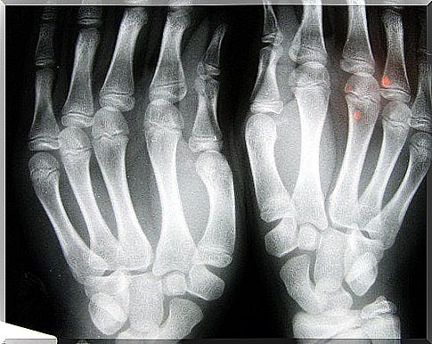 What your fingers say about the risk of developing osteoarthritis