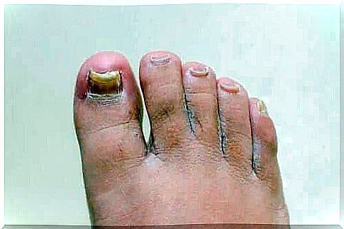 What onychomycosis treatments work?