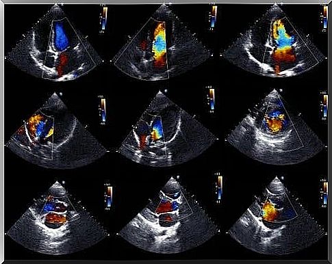 Pericardial effusion seen on ultrasound