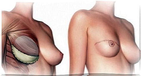 What you need to know about mastectomy surgery