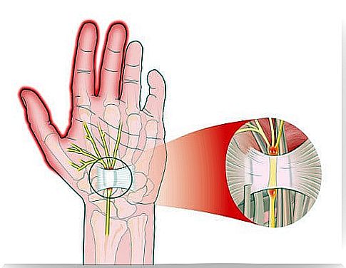 How I numb my hands in sleep because of the carpal nerve